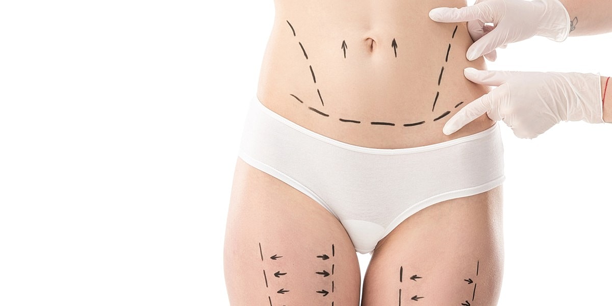 Body Lift Vs. Tummy Tuck: How To Decide