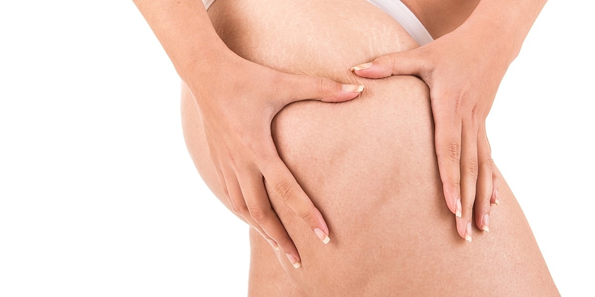 Thigh Lift For Cellulite: Will It Help?