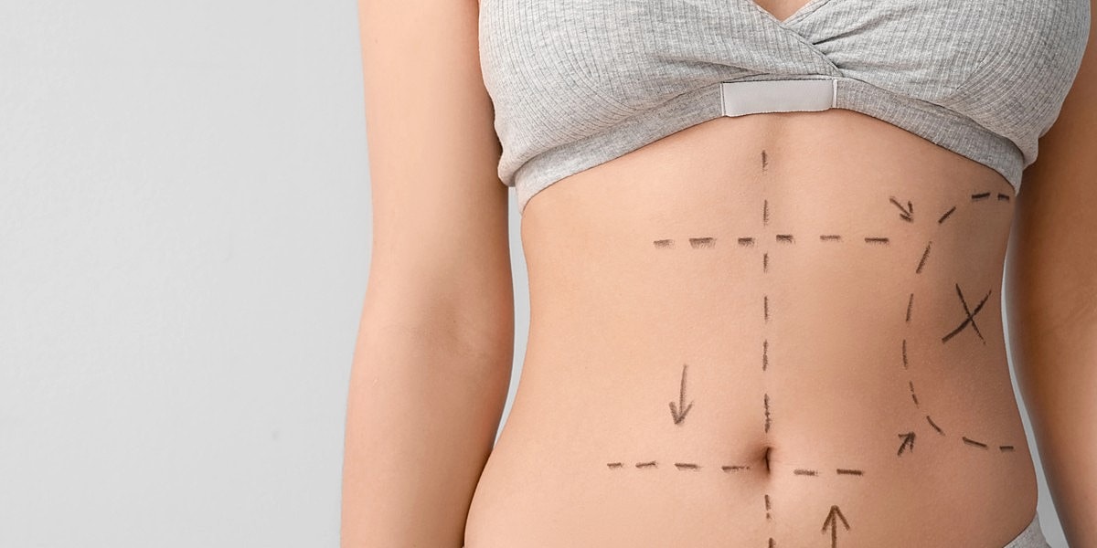 Tummy Tuck Vs. Mommy Makeover: Which Is The Right Fit For You?