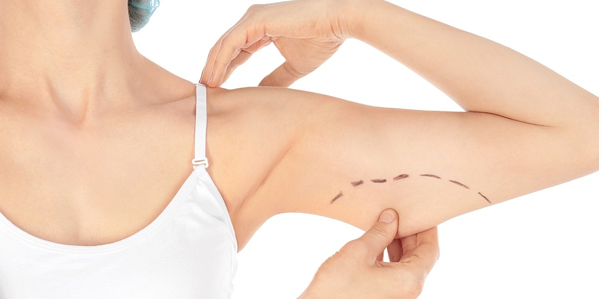 What Is A Brachioplasty Surgery?