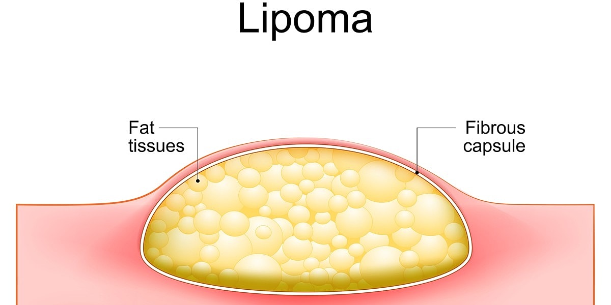 What To Expect During Lipoma Removal Recovery