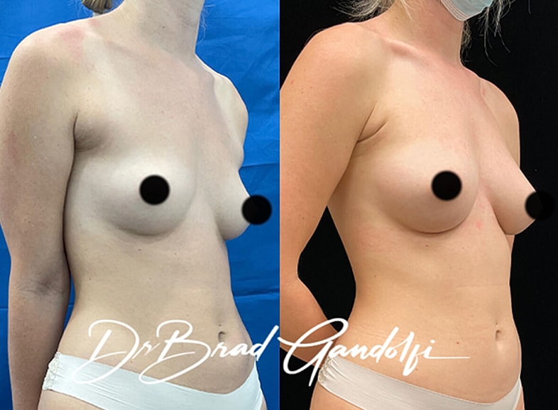 Before and after breast enhancement comparison.