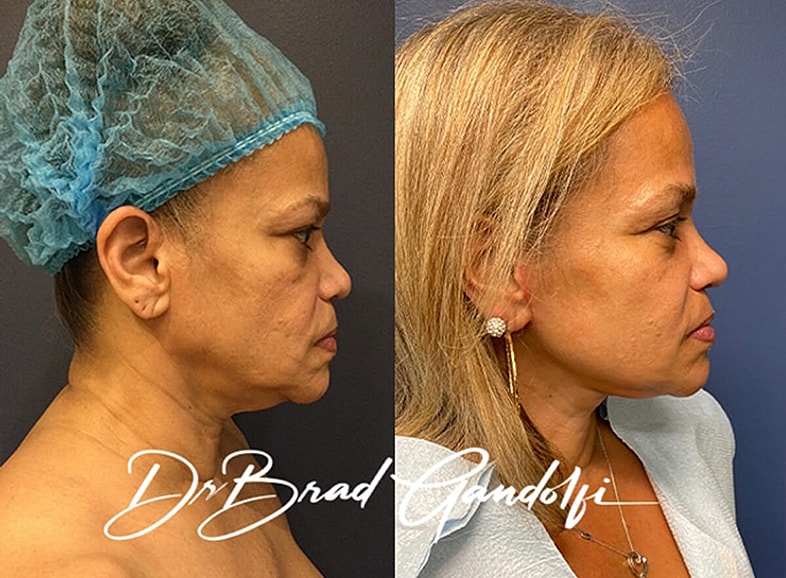 Before and after profile photo showing facelift results.
