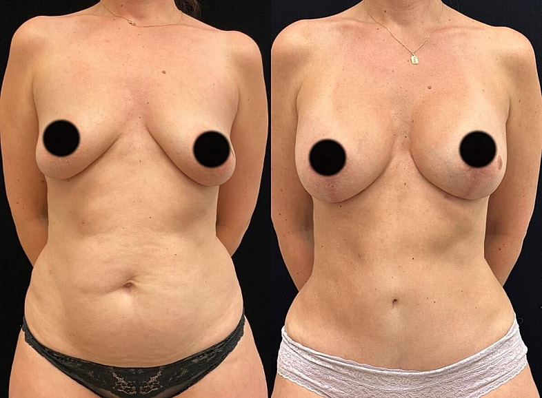 Before and after body transformation comparison.