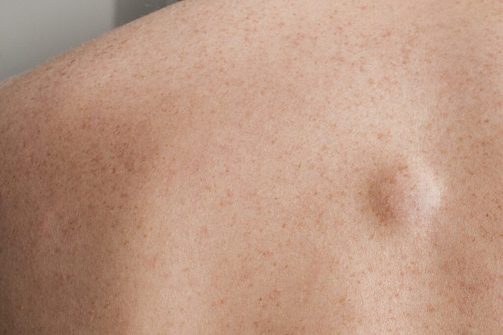 Close-up of skin texture on a back.