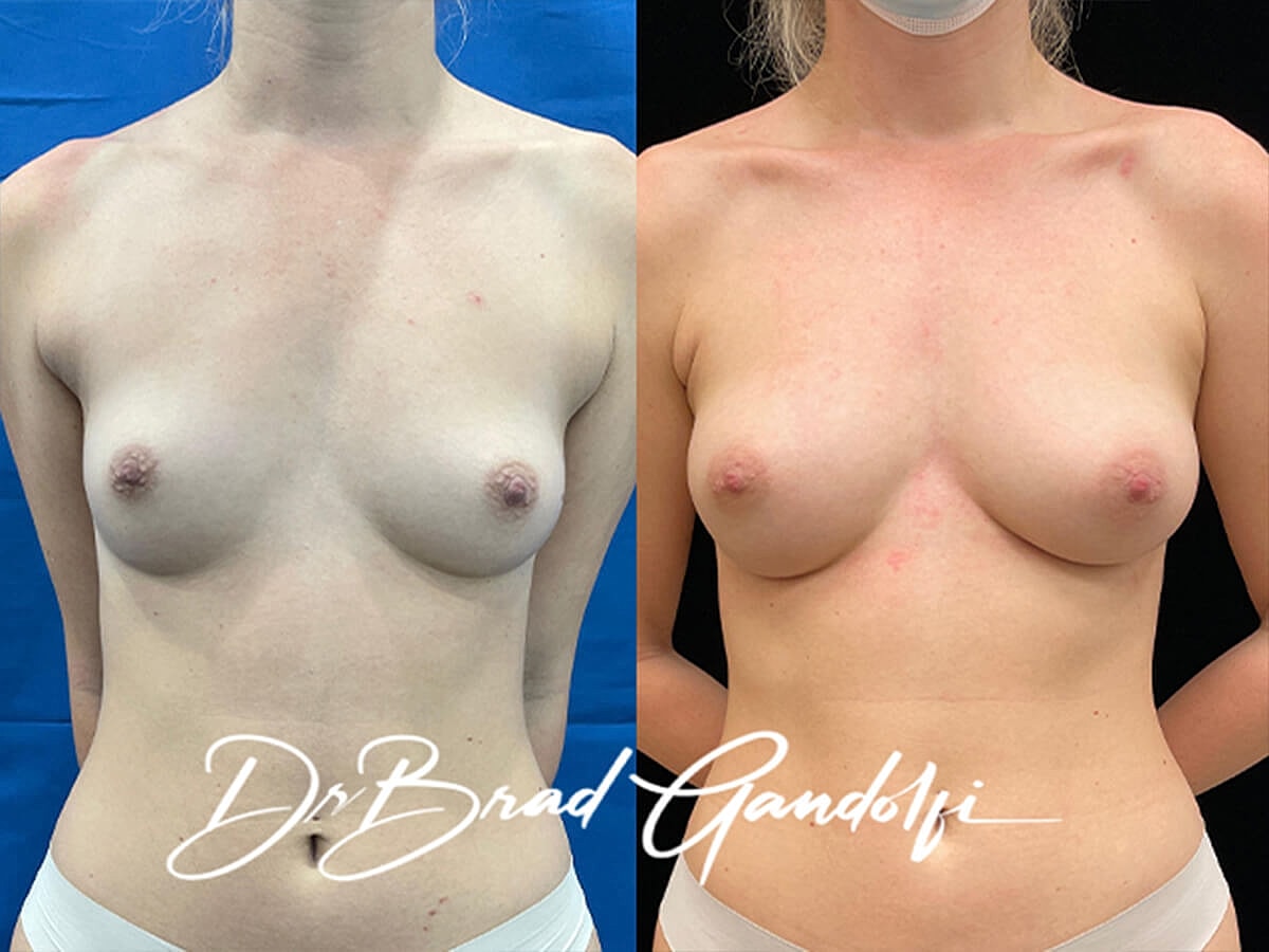 Breast Fat Transfer Before & After
