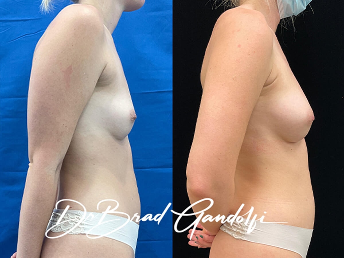 Breast Fat Transfer Before & After