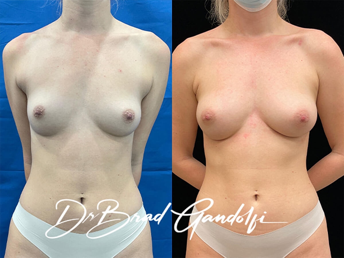 Breast Fat Transfer Before & After