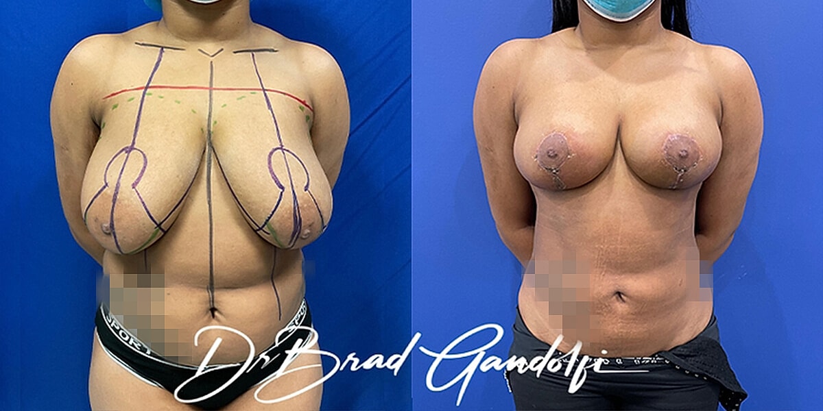 Breast Reduction Before & After