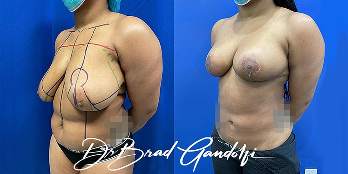 Breast Reduction Before & After