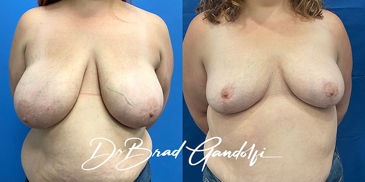 Breast Reduction Before & After