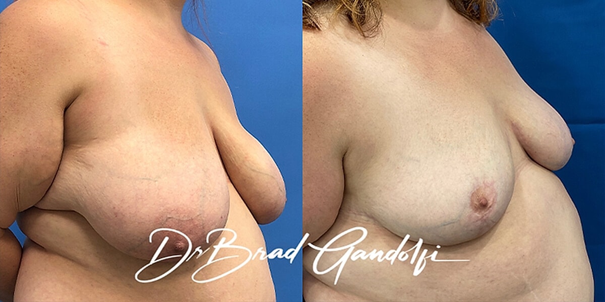 Breast Reduction Before & After
