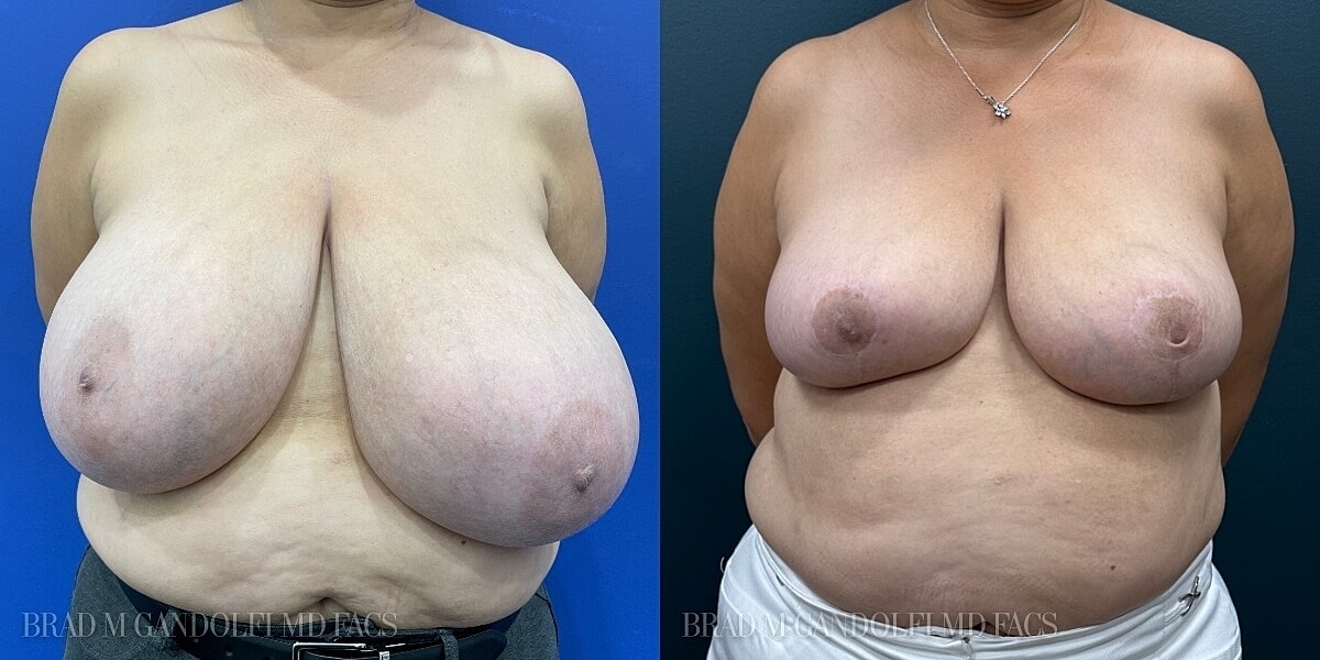 Breast Reduction Before & After