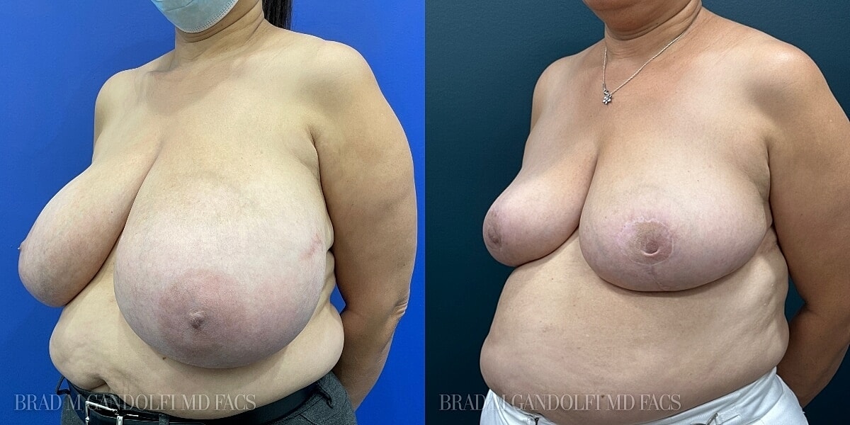 Breast Reduction Before & After