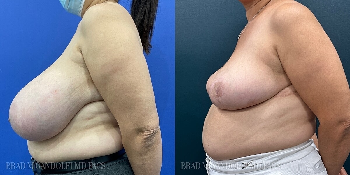 Breast Reduction Before & After