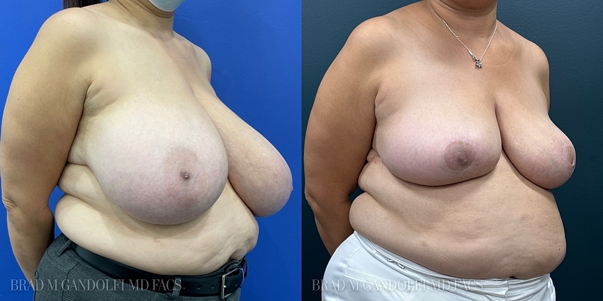 Breast Reduction Before & After