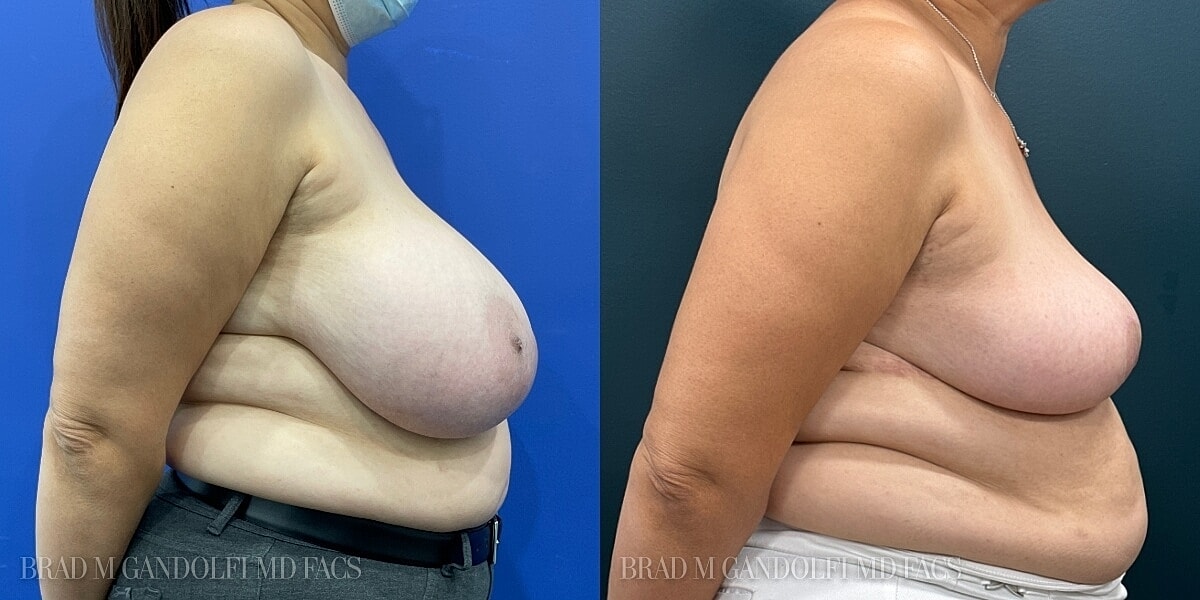 Breast Reduction Before & After