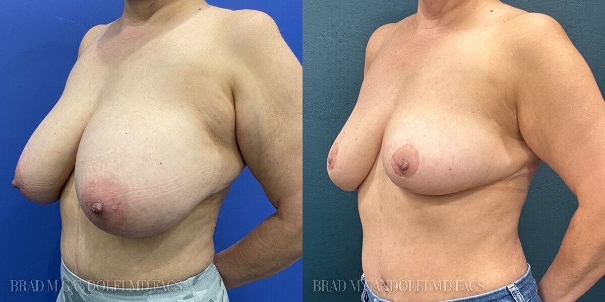 Breast Reduction Before & After