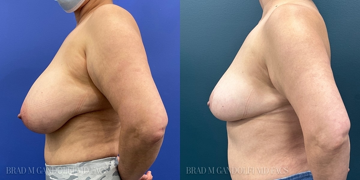Breast Reduction Before & After