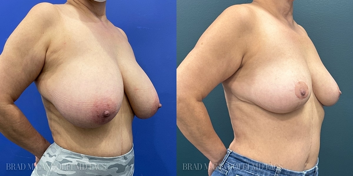 Breast Reduction Before & After