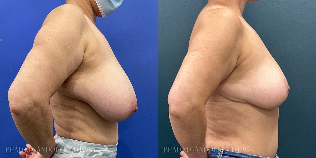 Breast Reduction Before & After