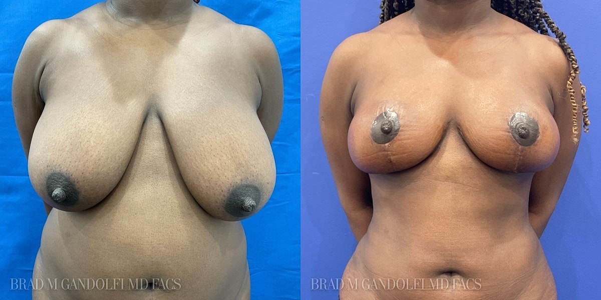 Breast Reduction Before & After