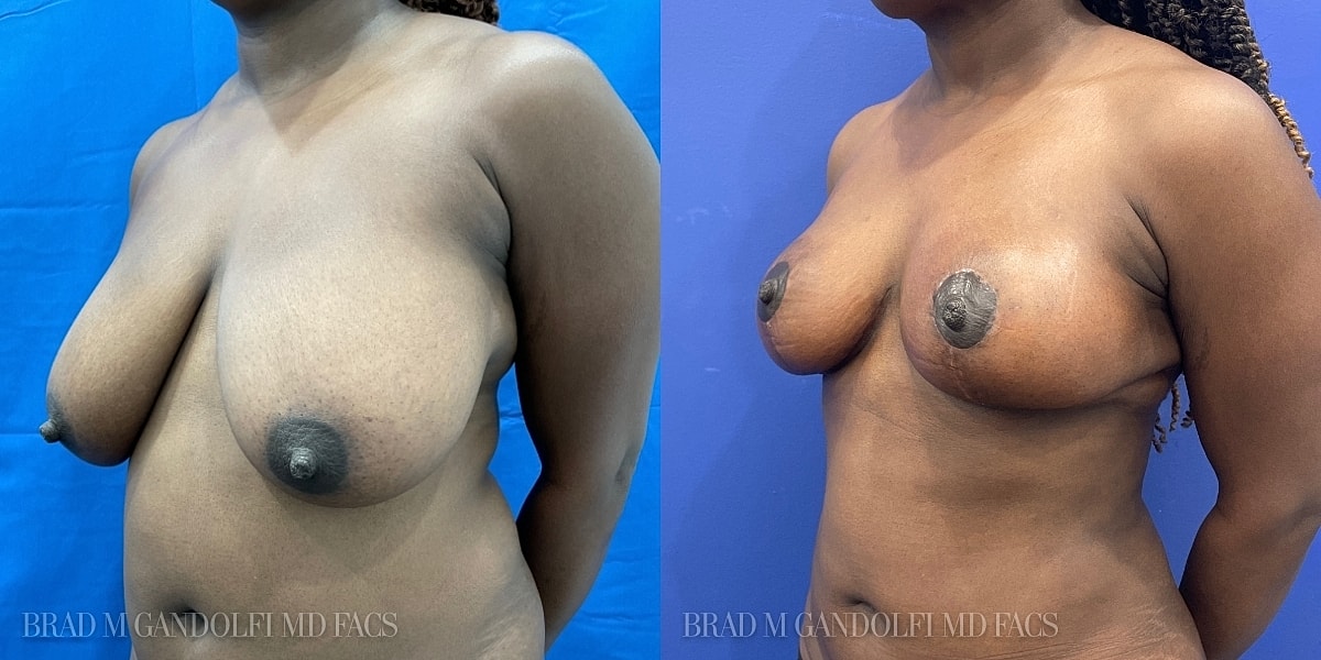 Breast Reduction Before & After