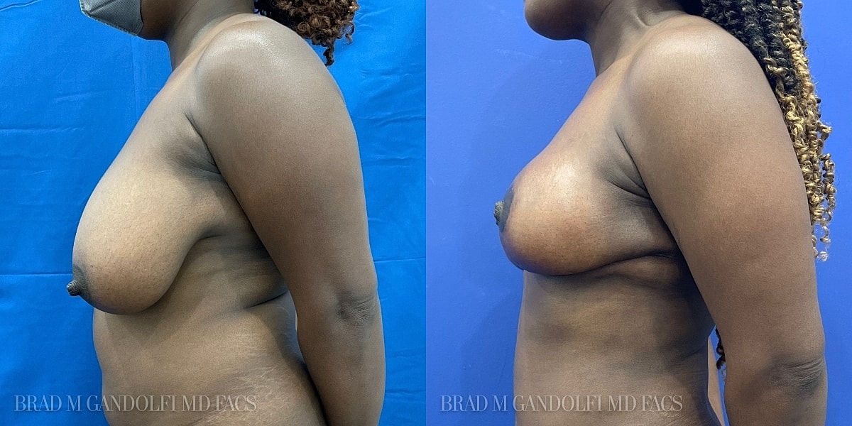 Breast Reduction Before & After