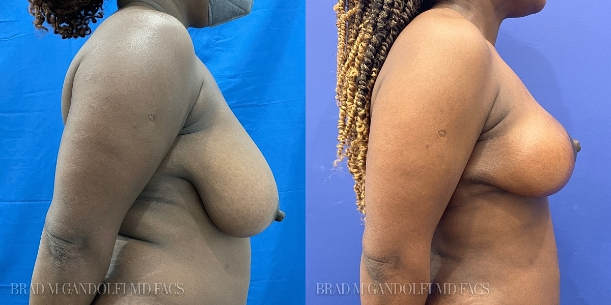 Breast Reduction Before & After