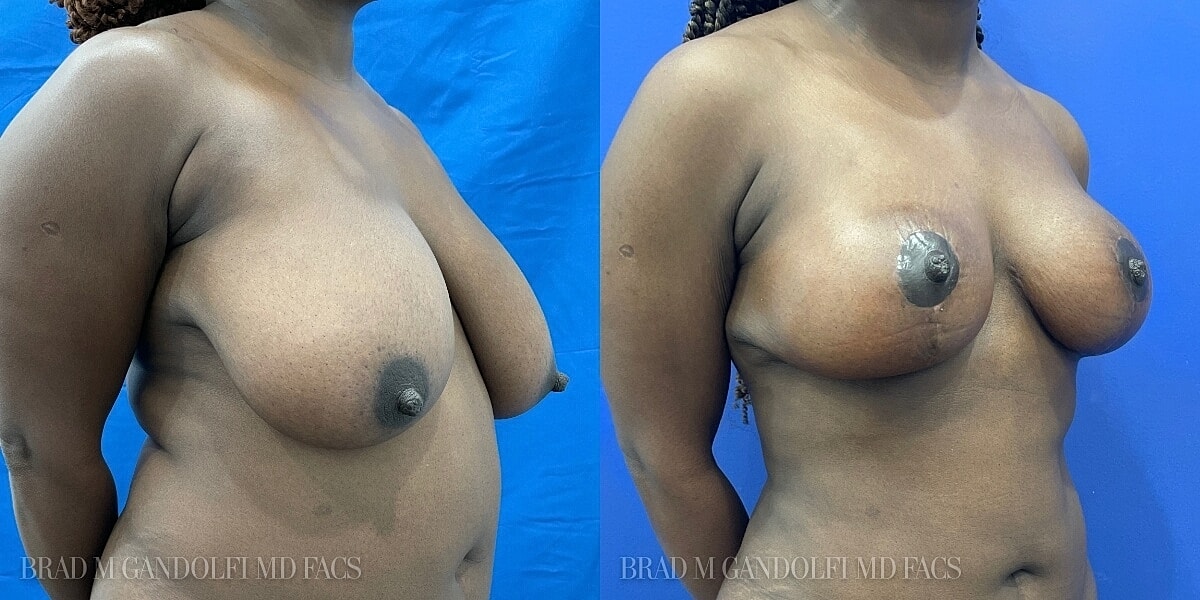 Breast Reduction Before & After