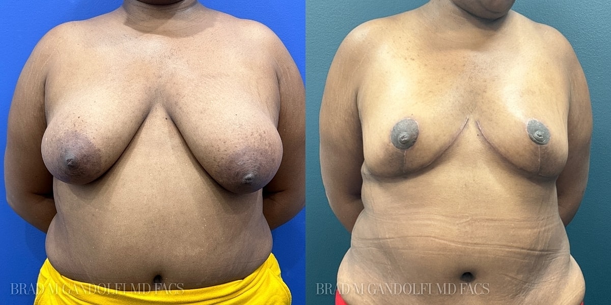 Breast Reduction Before & After