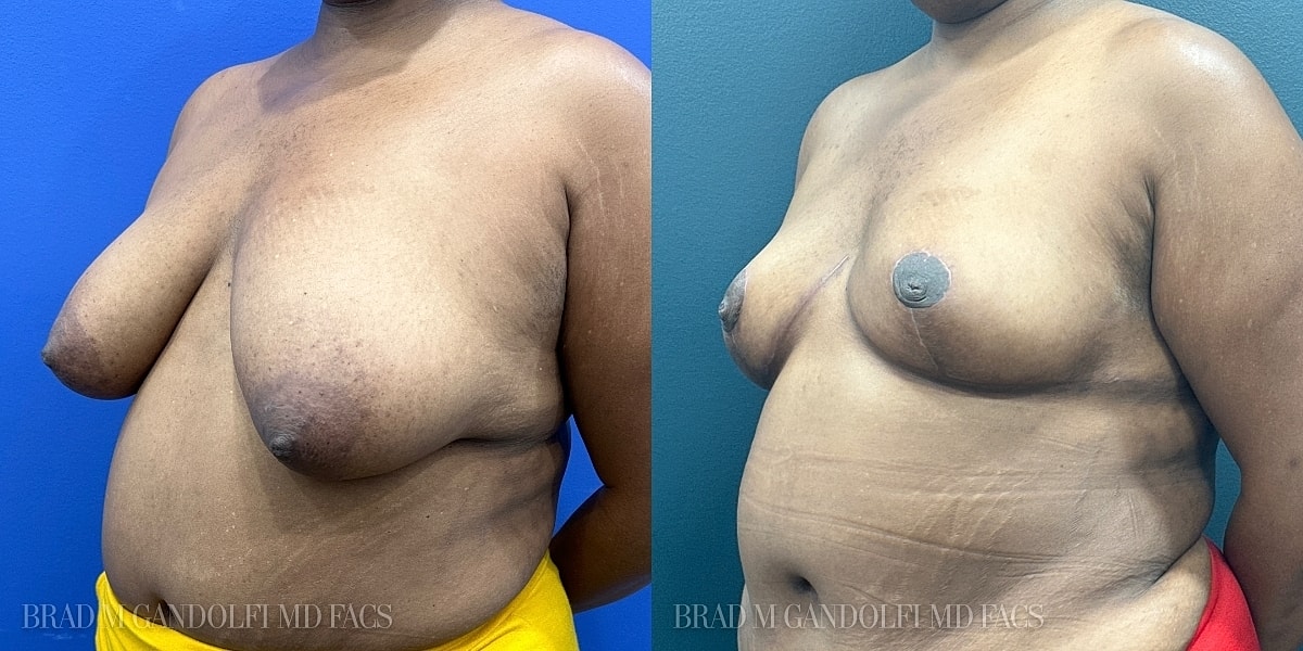 Breast Reduction Before & After