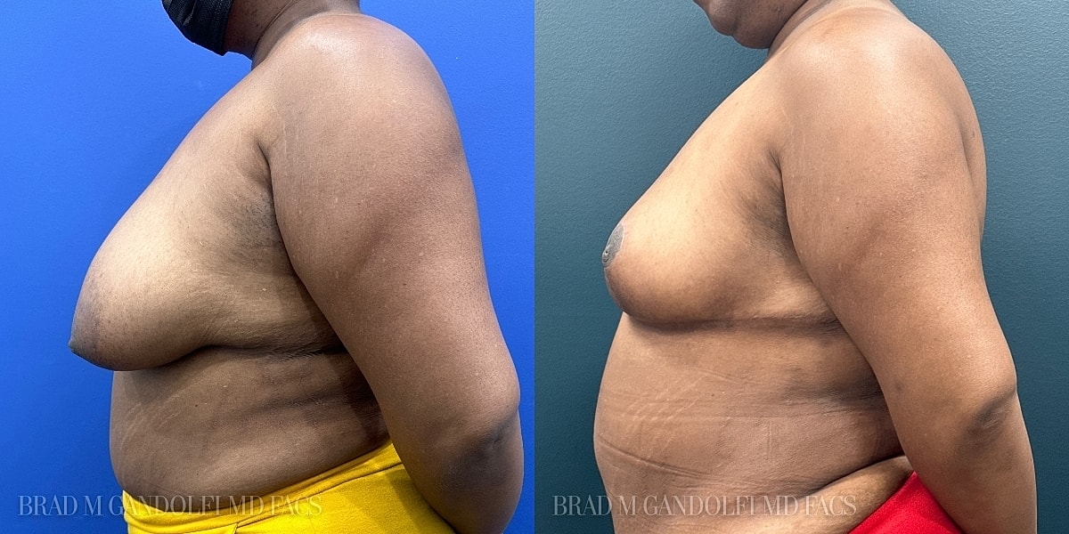 Breast Reduction Before & After