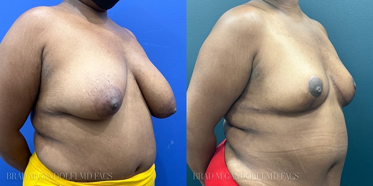 Breast Reduction Before & After