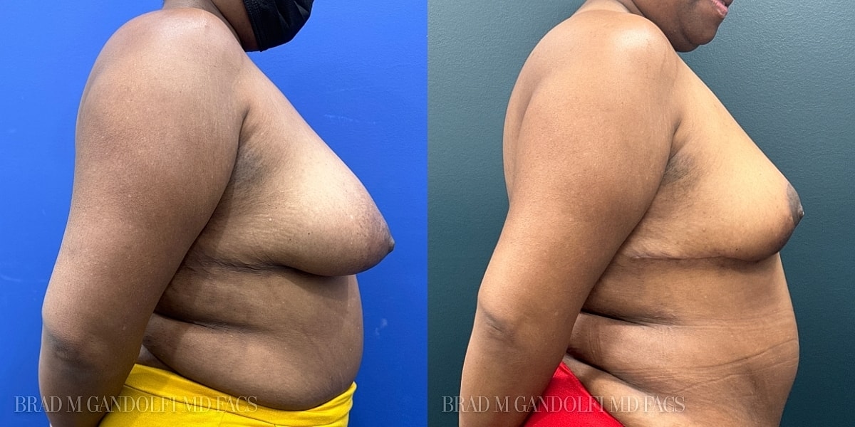Breast Reduction Before & After