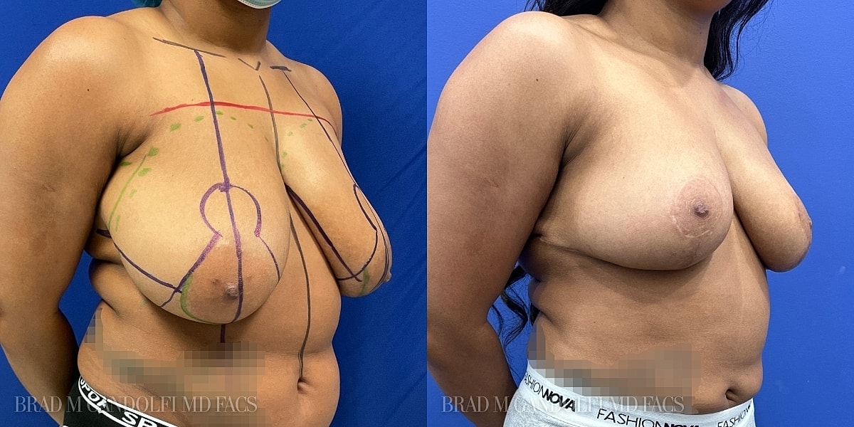 Breast Reduction Before & After