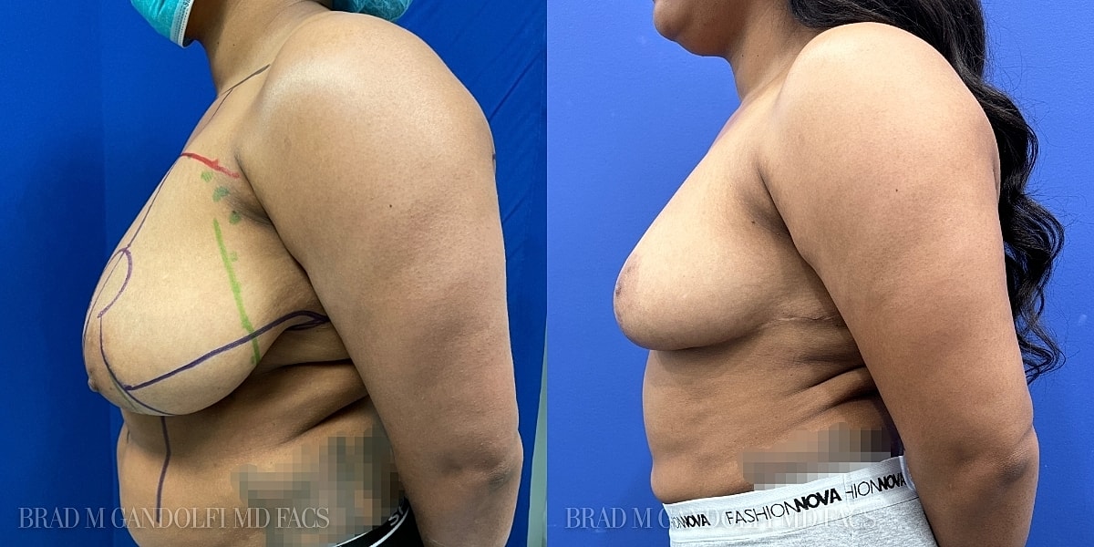 Breast Reduction Before & After