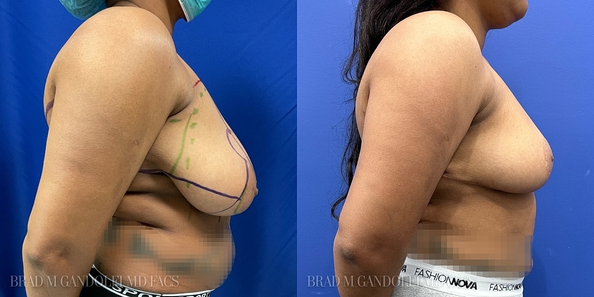 Breast Reduction Before & After