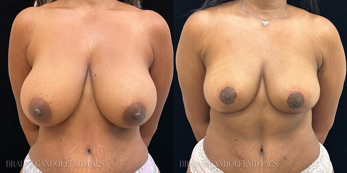 Breast Reduction Before & After