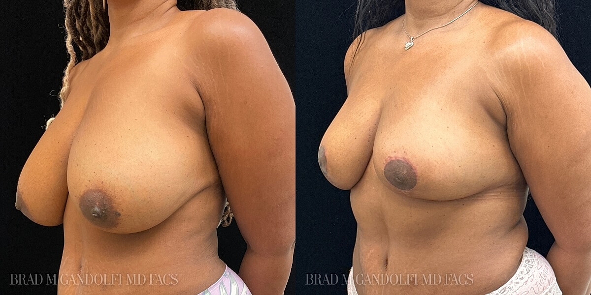 Breast Reduction Before & After