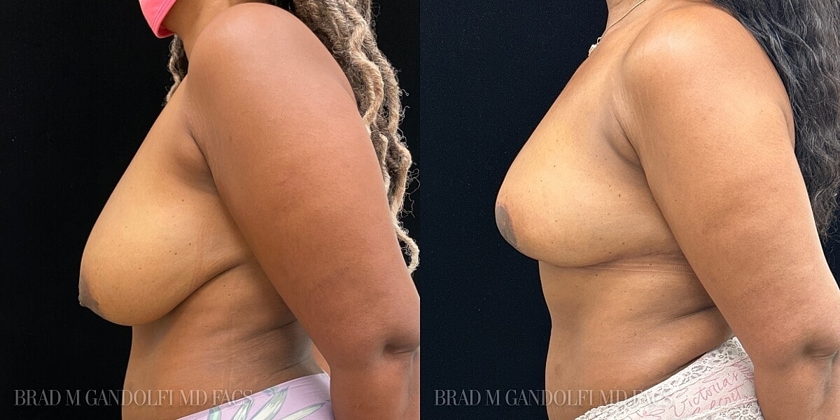 Breast Reduction Before & After