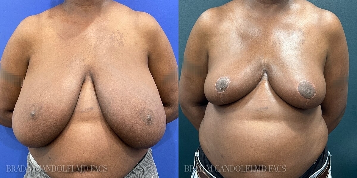 Breast Reduction Before & After