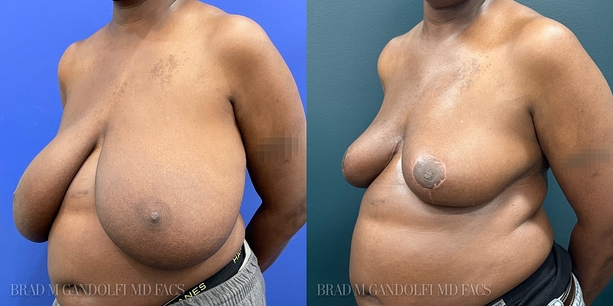 Breast Reduction Before & After