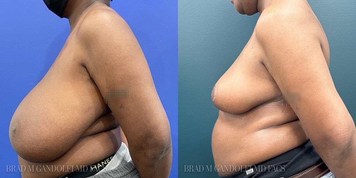 Breast Reduction Before & After