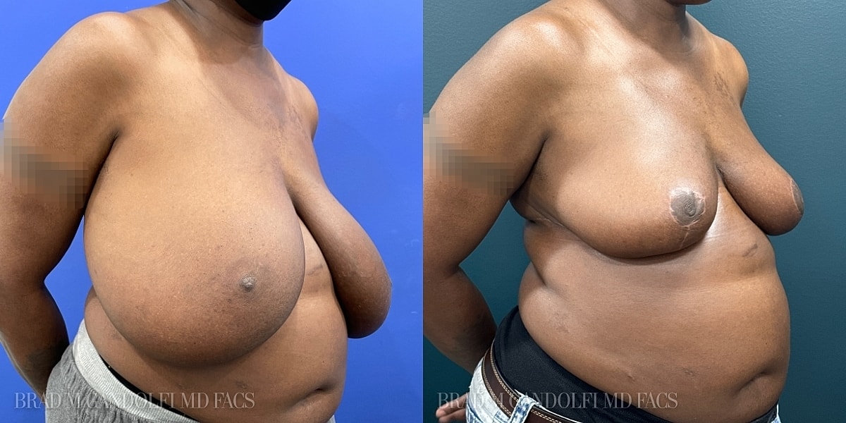 Breast Reduction Before & After