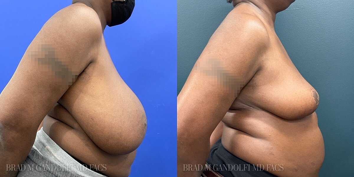 Breast Reduction Before & After