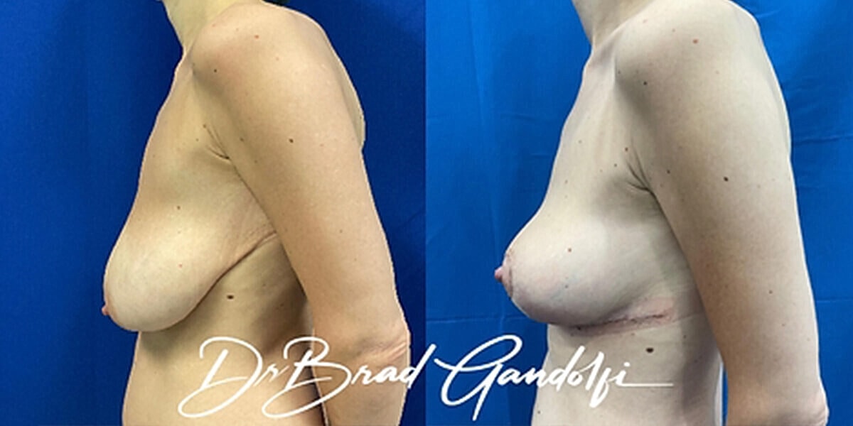 Breast Lift Before & After