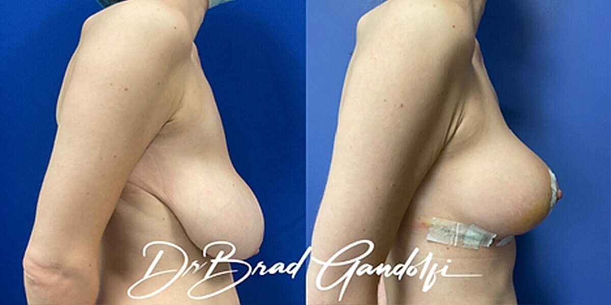 Breast Lift Before & After