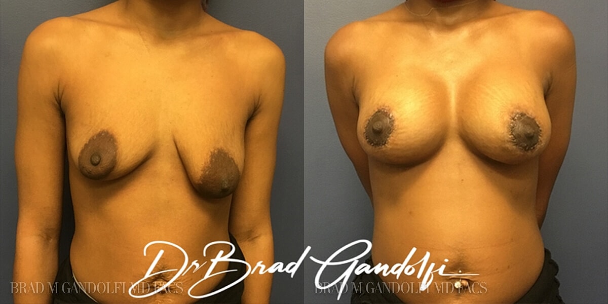 Breast Lift Before & After