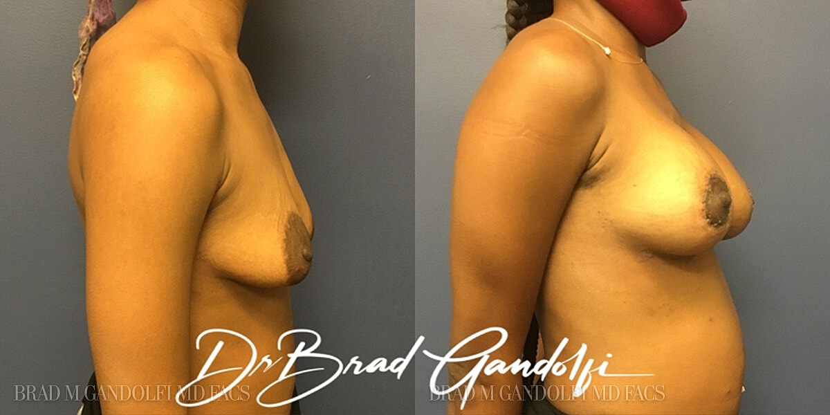 Breast Lift Before & After